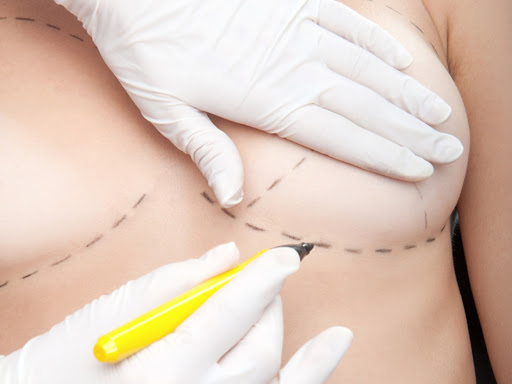Desplazamiento De Implantes Mamarios Cirugia | Dr. César Padilla, Málaga