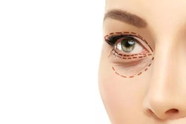 Adiós a la mirada cansada y triste con la cirugía de párpados