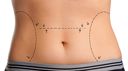Liposuccion malaga