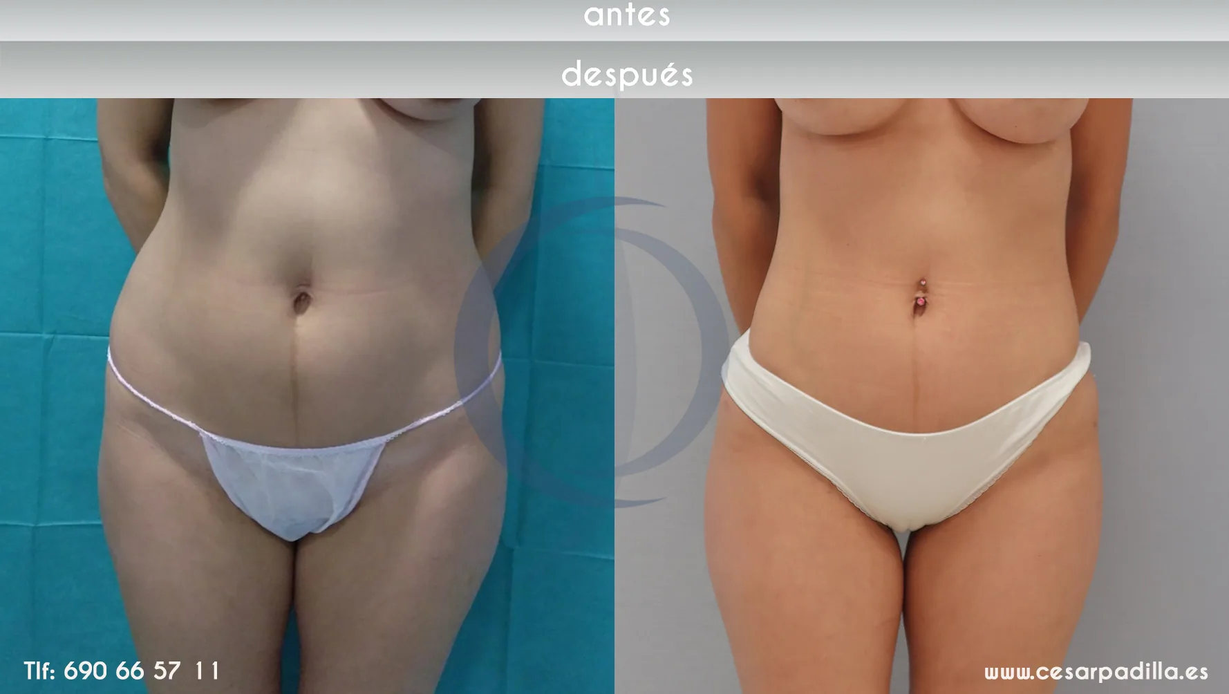 Liposuction suction CASO 2 FRONT