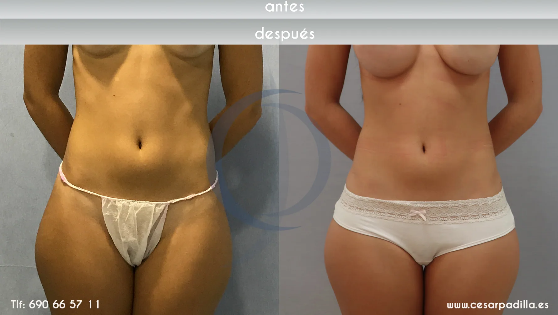 Liposuction suction CASO 3 front