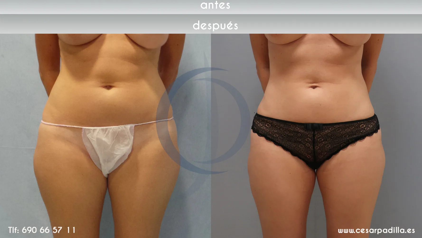 Liposuction suction CASO 6 front