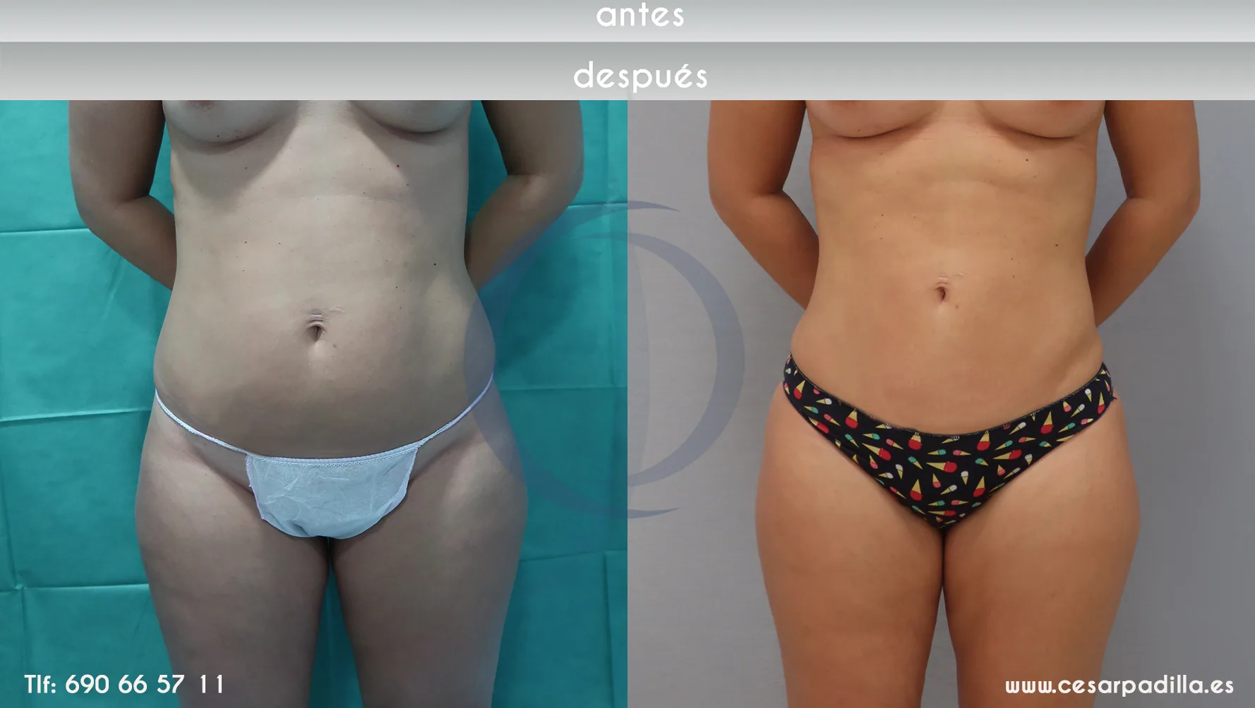Liposuction suction CASO 7 front
