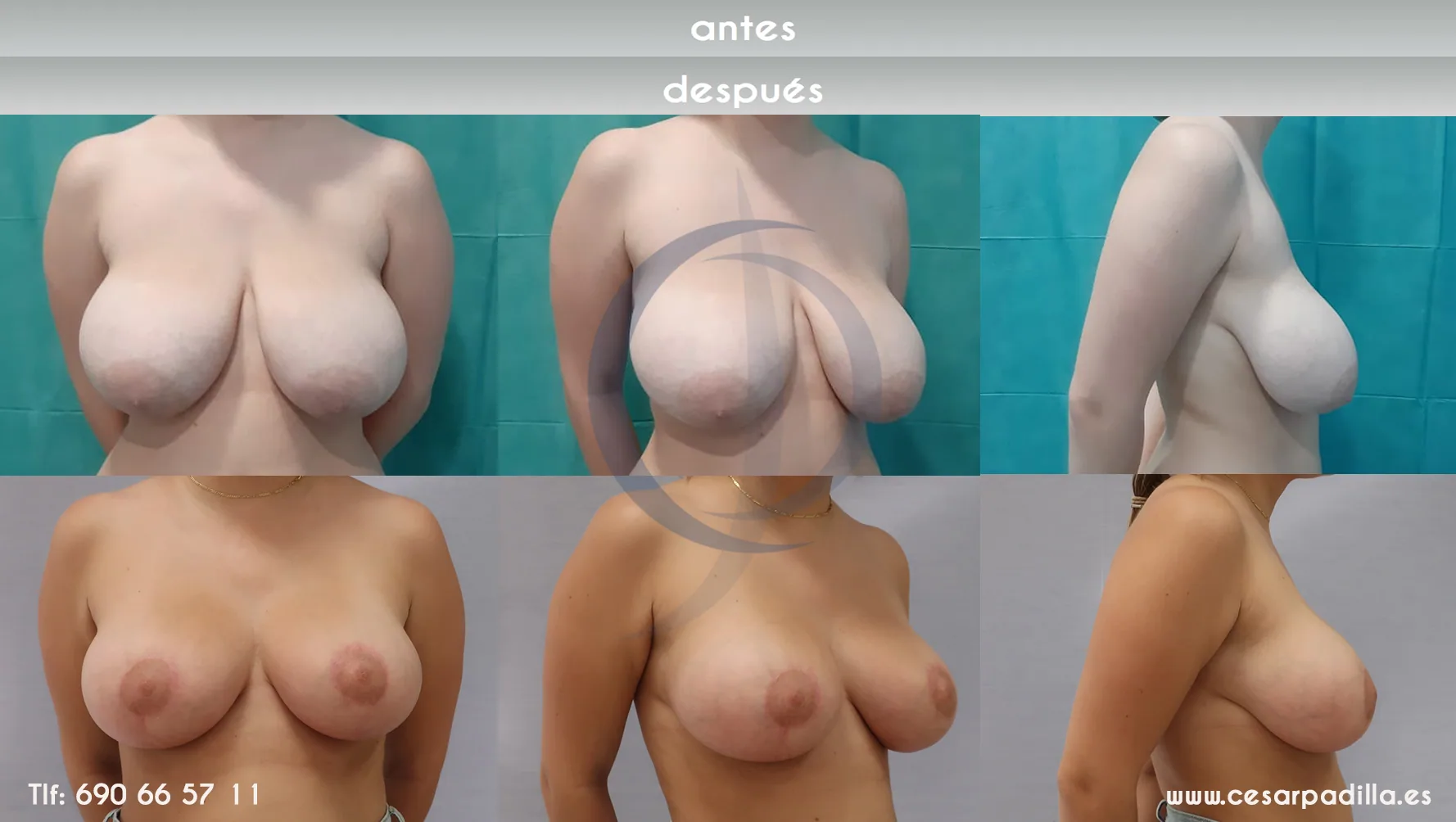Mastopexy lollypop case 18