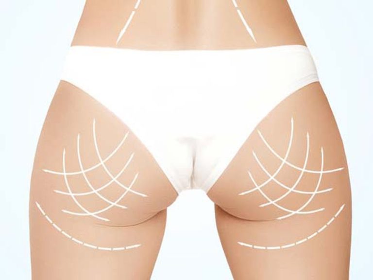 ¿En qué zonas puedo hacerme una Liposucción?