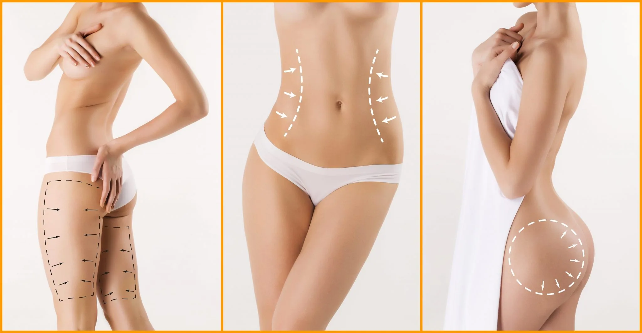 Liposuccion malaga laser