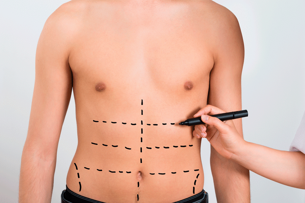 Liposuccion malaga marcacion abdominal