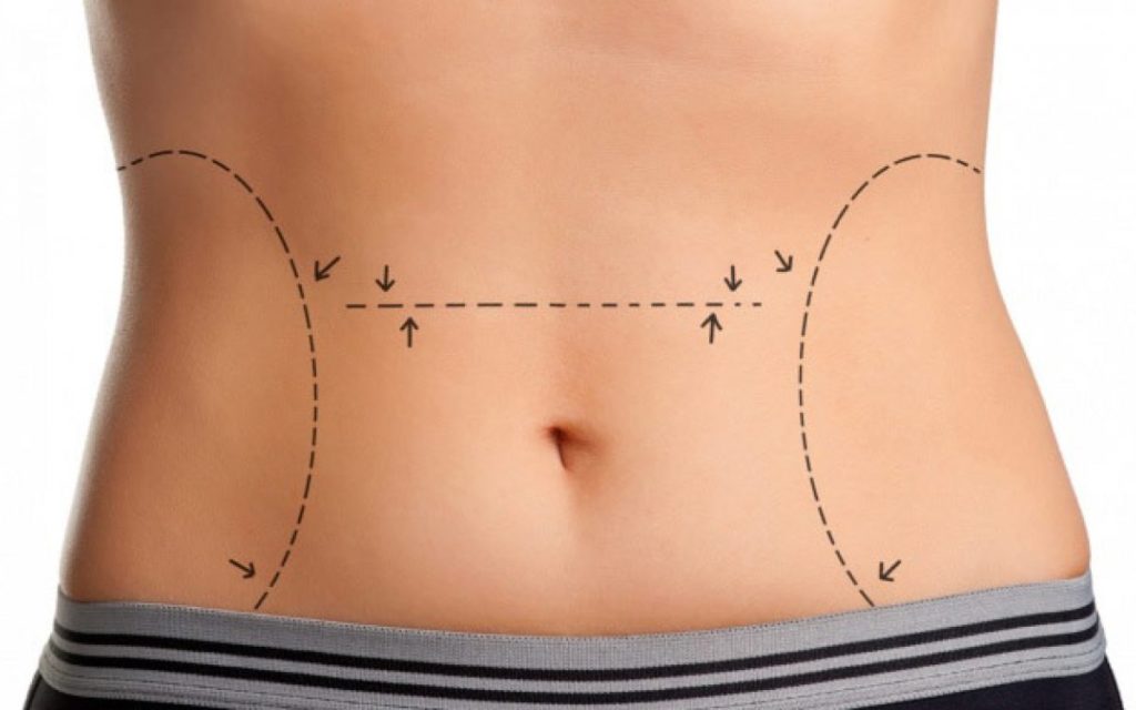 Liposuccion malaga medidas