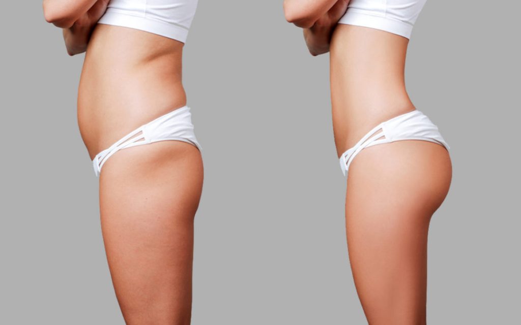 la abdominoplastia o la liposucción