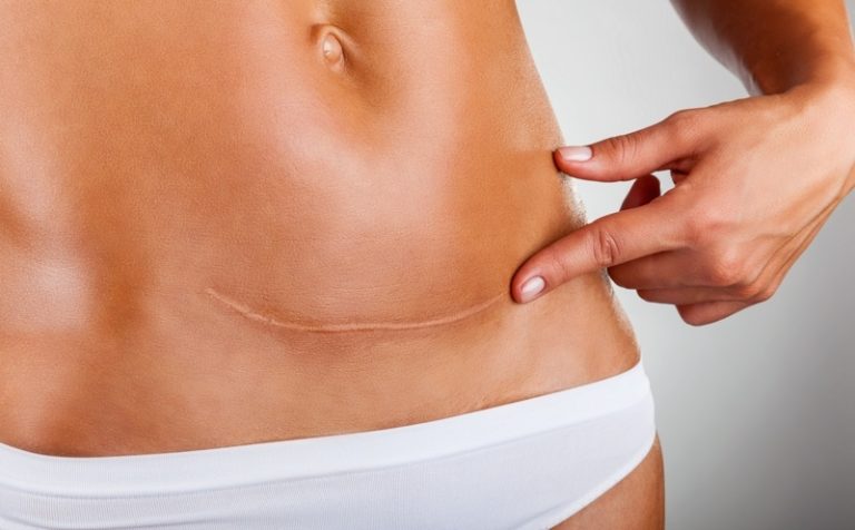 ¿Cómo debe quedar la cicatriz de una abdominoplastia?