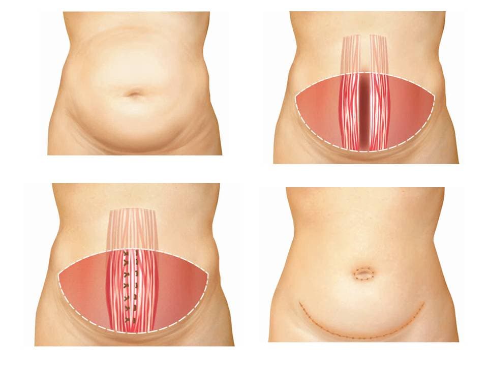 Abdominoplastia | Dr. César Padilla, Málaga