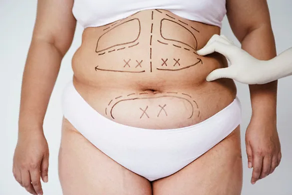 Que no debo hacer si tengo diastasis abdominal