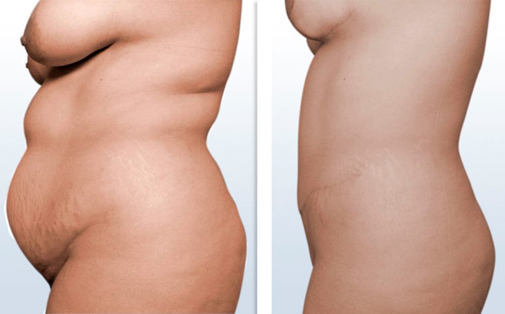 Lipectomiaabdominal | Dr. César Padilla, Málaga