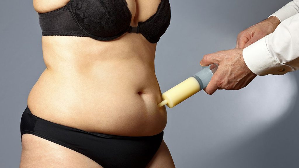 cuanto dura la cirugia de abdominoplastia