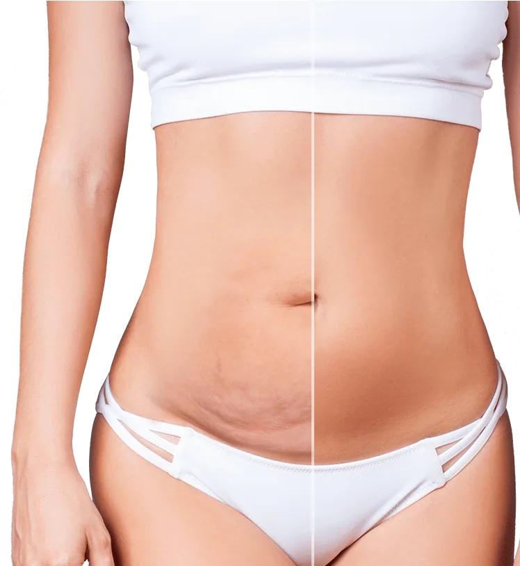 Mini tummy tuck