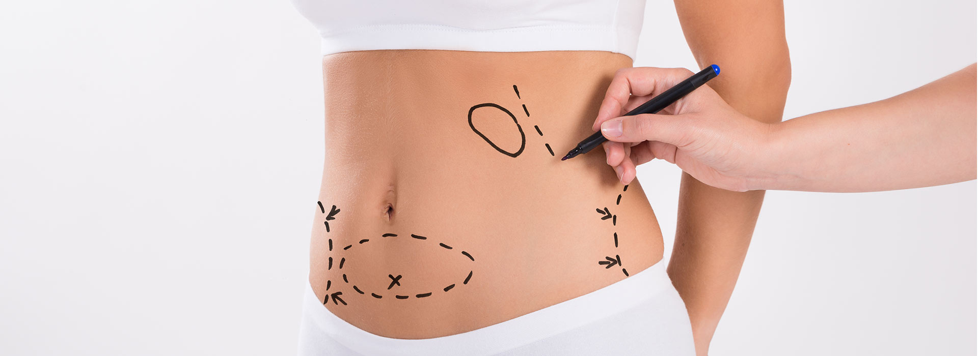 ¿Puedo quedar embarazada después una abdominoplastia?