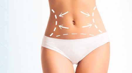 ¿Qué es mejor, la abdominoplastia o la liposucción?
