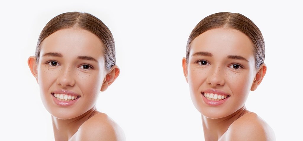 Otoplastia Beneficios | Dr. César Padilla, Málaga