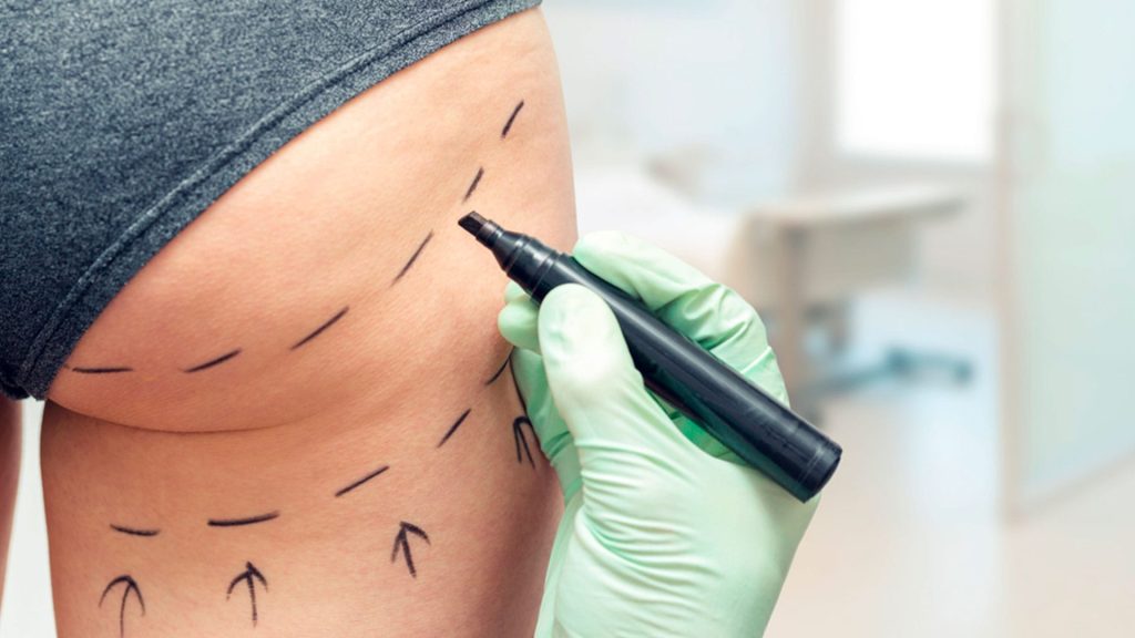 Aumento De Gluteo | Dr. César Padilla, Málaga