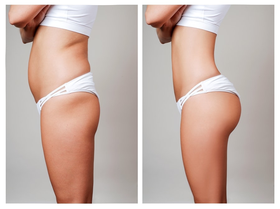 Female Body Before And After Treatment. Plastic Surgery. | Dr. César Padilla, Málaga