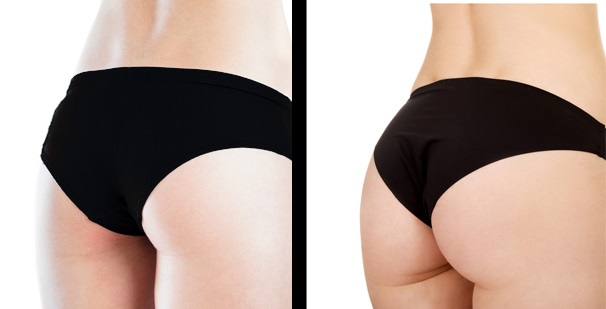 Brazillian Butt Lift Fat Transfer Before After Side | Dr. César Padilla, Málaga