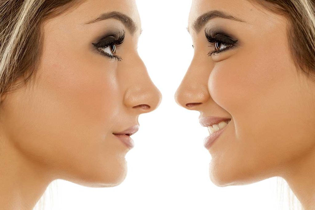 Rinoplastia ultrasonica