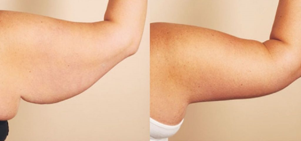 Braquioplastia Antes Despues | Dr. César Padilla, Málaga