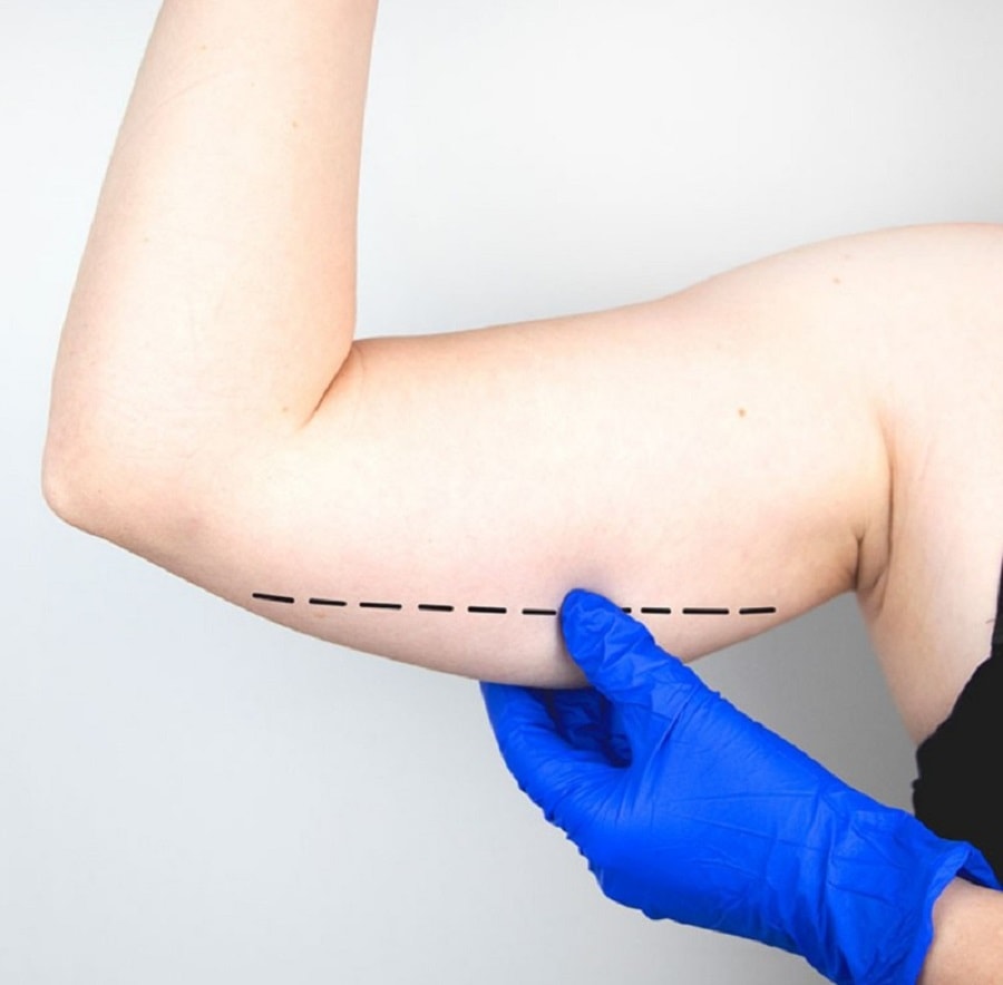 Braquioplastia Resultados | Dr. César Padilla, Málaga