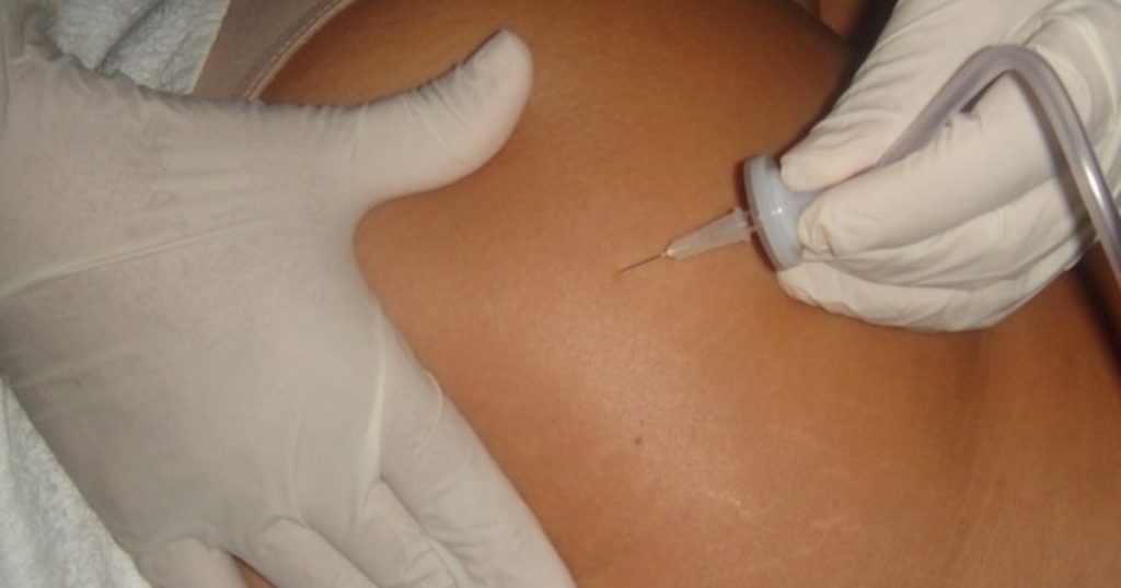 Carboxiterapia Celulitis | Dr. César Padilla, Málaga