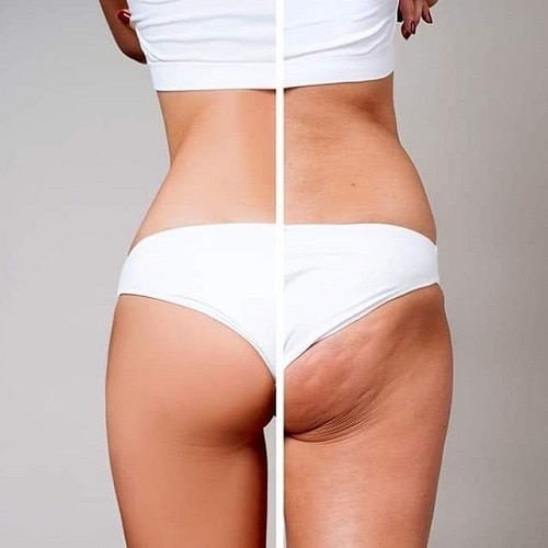 Celulitis Dr Padilla | Dr. César Padilla, Málaga