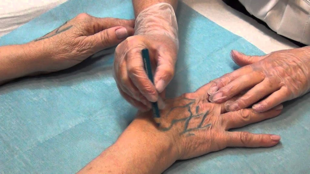 Rejuvenecer Manos Malaga Dr Padilla | Dr. César Padilla
