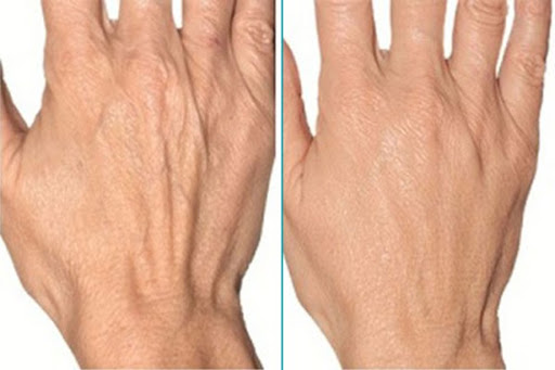 Rejuvenecer Manos Malaga | Dr. César Padilla