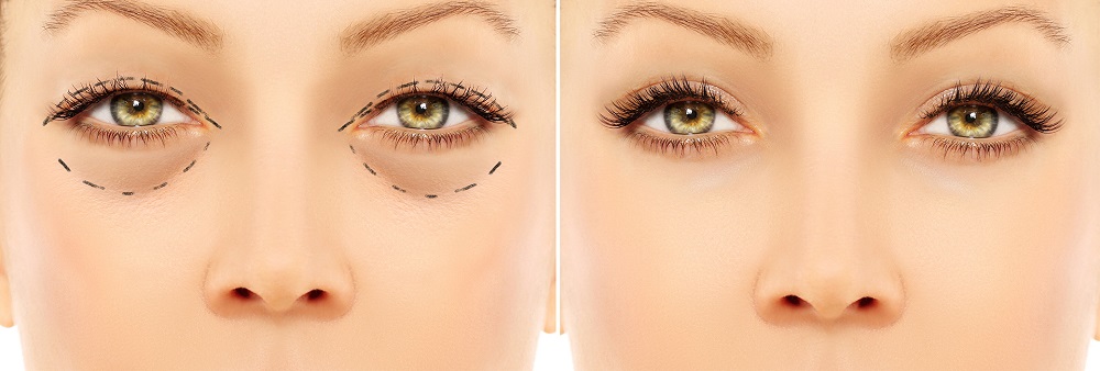 Blafaroplastia Cesar Padilla | Dr. César Padilla, Málaga