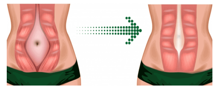 Diastasis abdominal malaga