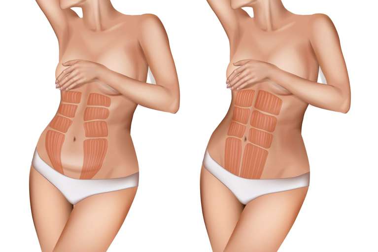 5 mitos de la Diástasis Abdominal: ¡Dile adiós al abdomen abultado!
