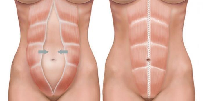 Marcacion Abdominal Malaga Padilla | Dr. César Padilla