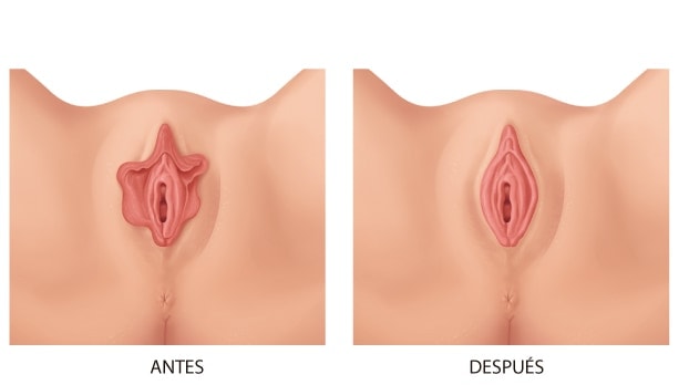 Vaginoplastia Español | Dr. César Padilla, Málaga