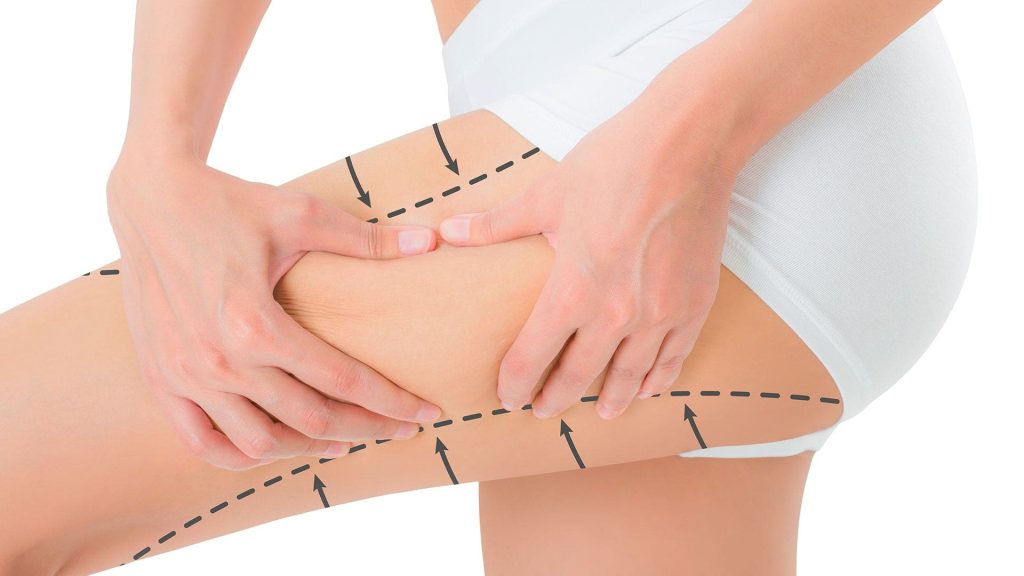 Lifting De Muslos | Dr. César Padilla, Málaga