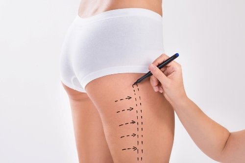 lifting-muslos Lifting Muslos | Dr. César Padilla, Málaga