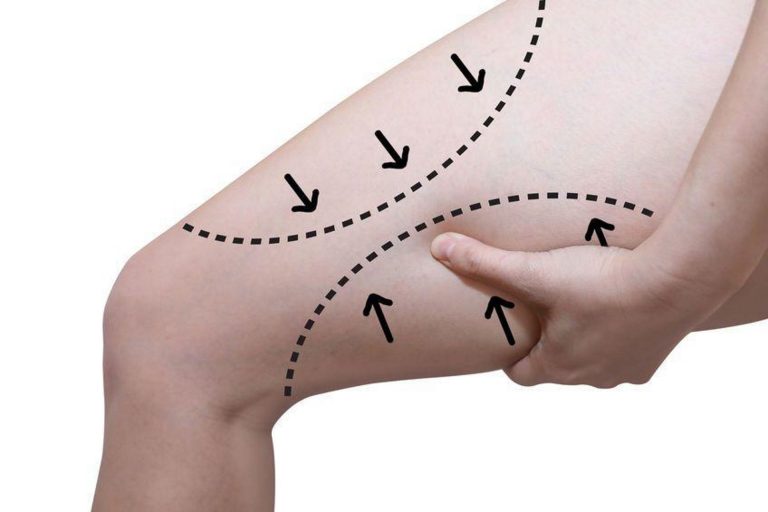 Lifting de Muslos ¿es efectivo para tonificar las piernas?