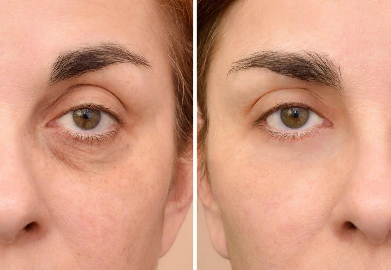 como_quitar_las_ojeras_oscuras Como Quitar Las Ojeras Oscuras | Dr. César Padilla, Málaga