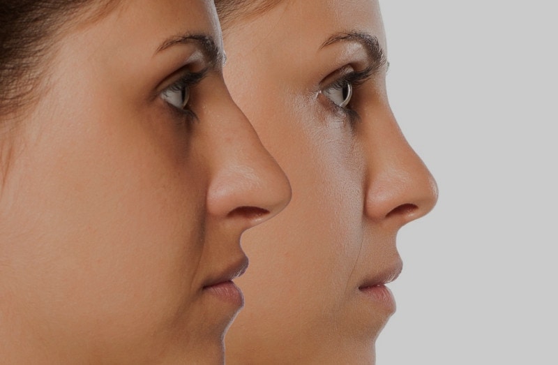 comparative portrait of a young woman before and after nose correction Comparative Portrait Of A Young Woman Before And After Nose Correction | Dr. César Padilla, Málaga