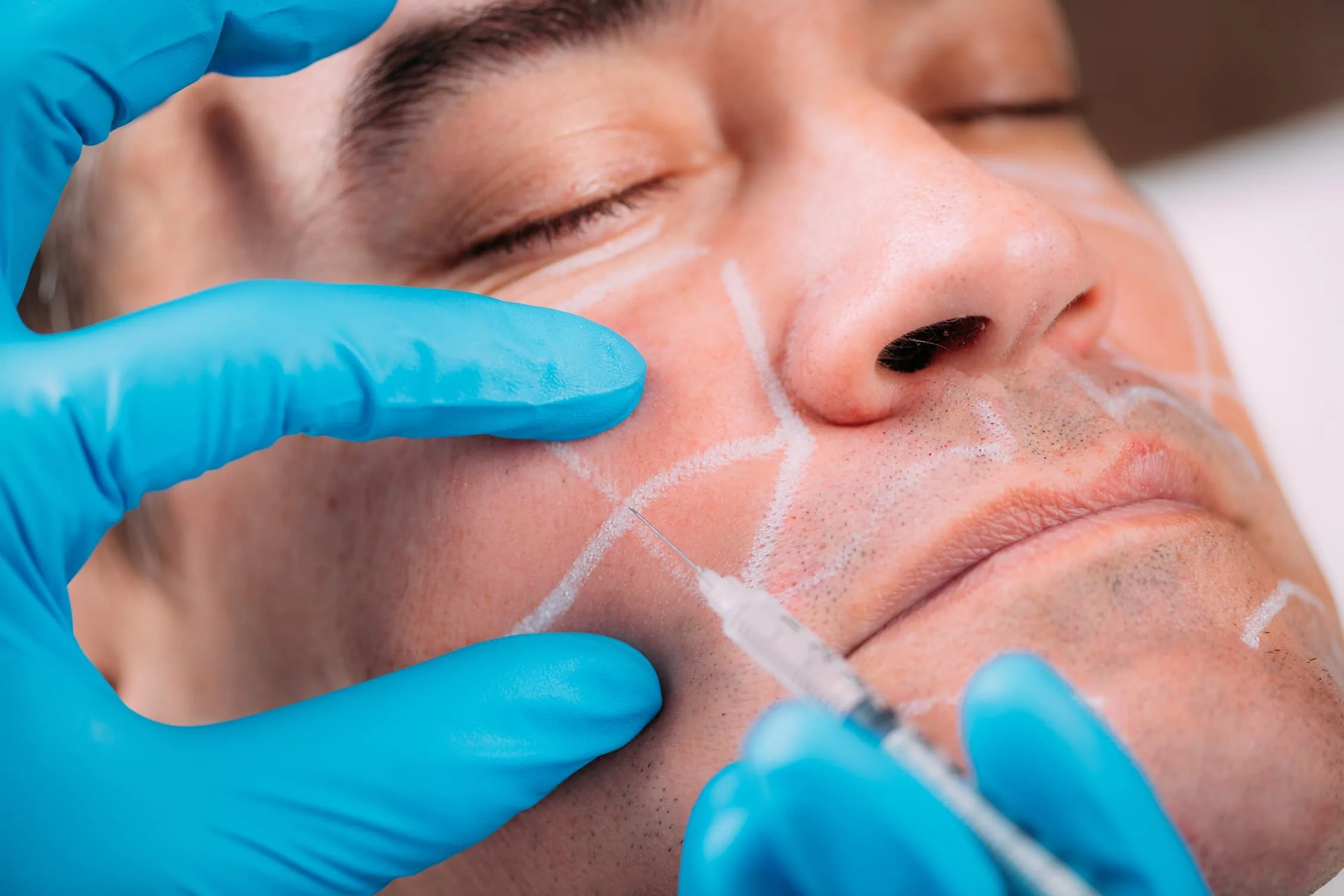 Dermal Filler Injection Men, Cheeks | Dr. César Padilla, Málaga