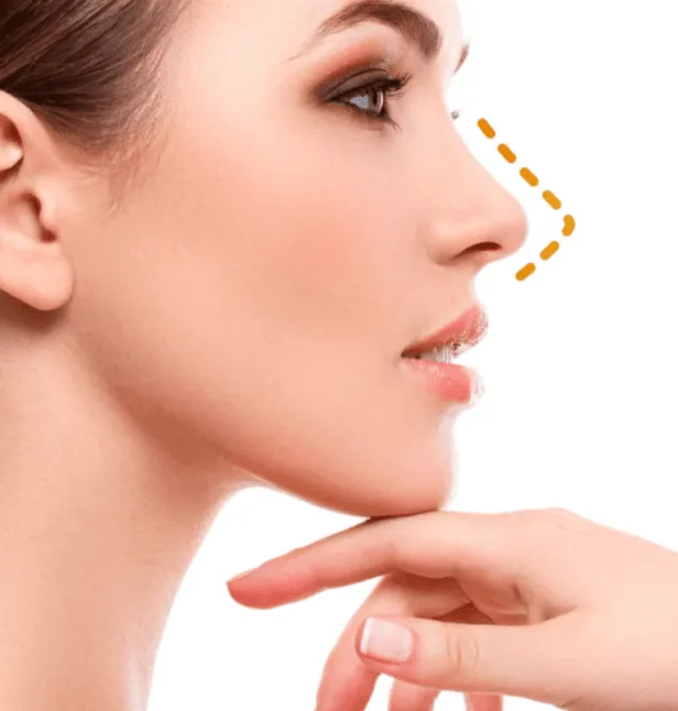 Cirugía de nariz: ¿por estética o por salud?