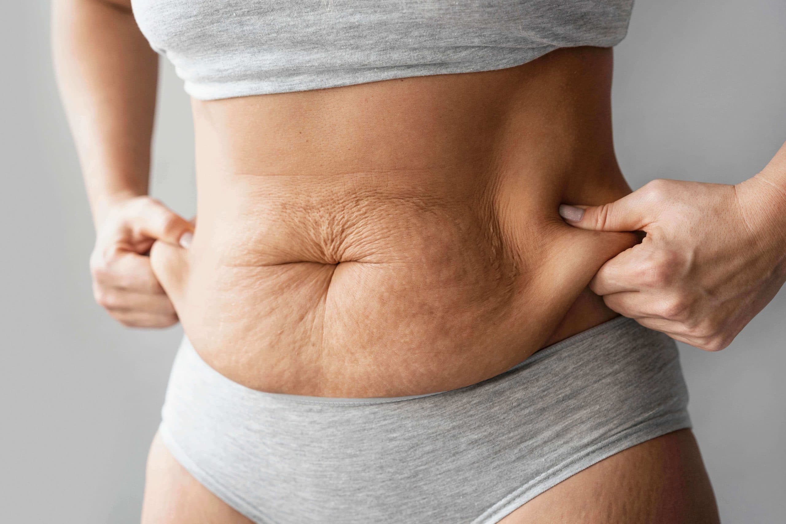 como puedo saber si tengo diastasis abdominal
