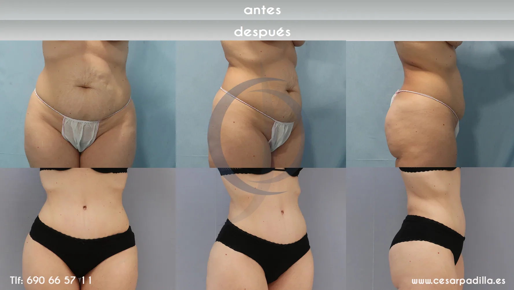 Abdominoplastia antes del verano mujer