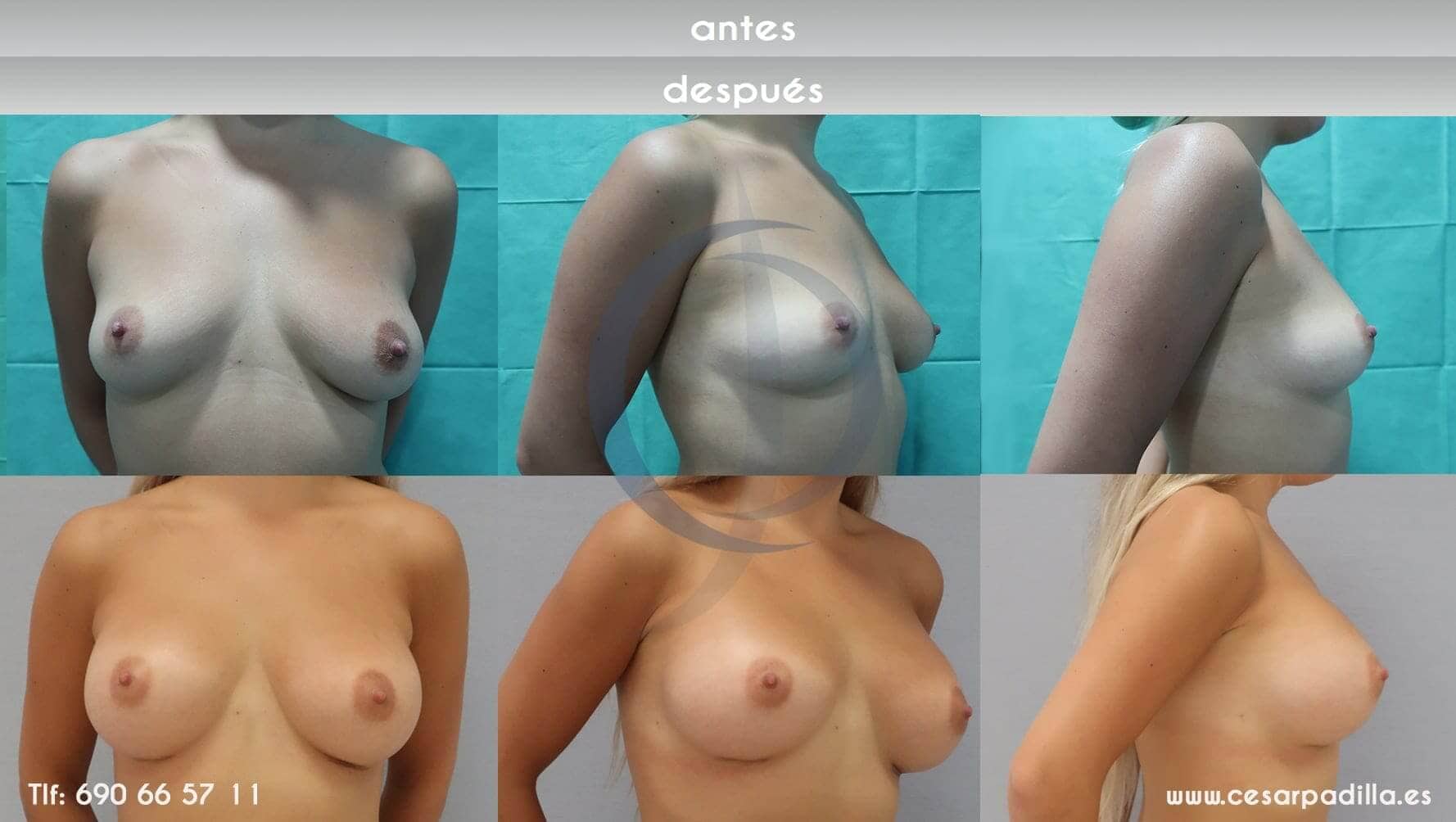 imagen del antes y depués de un aumento de pechos mixto con implantes y grasa