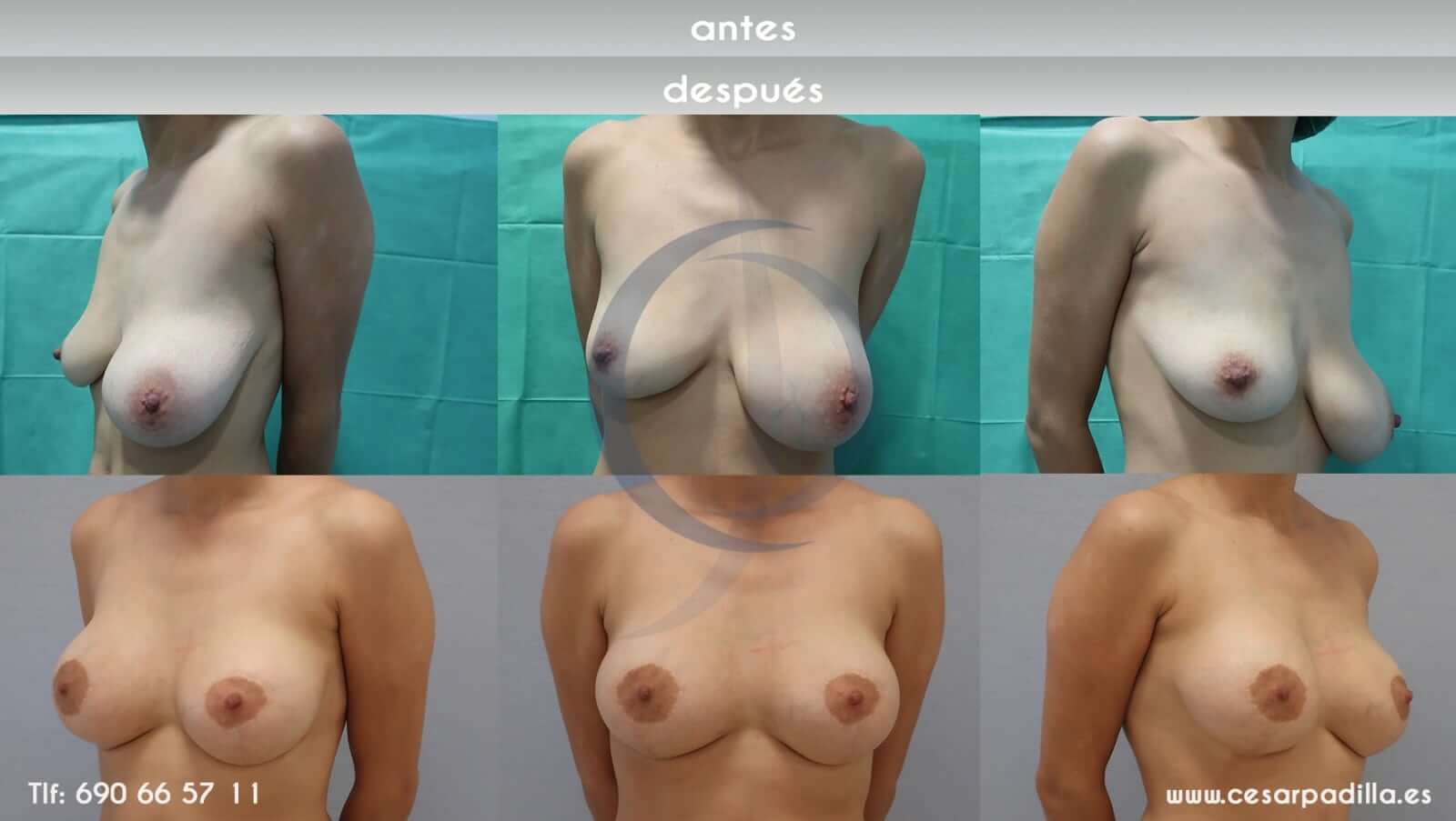 Simetrizacion de pechos antes y despues
