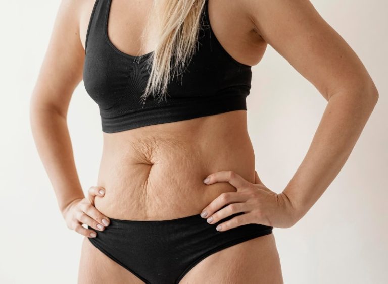 ¿Qué es la Diástasis Abdominal y Cómo Afecta tu Cuerpo?