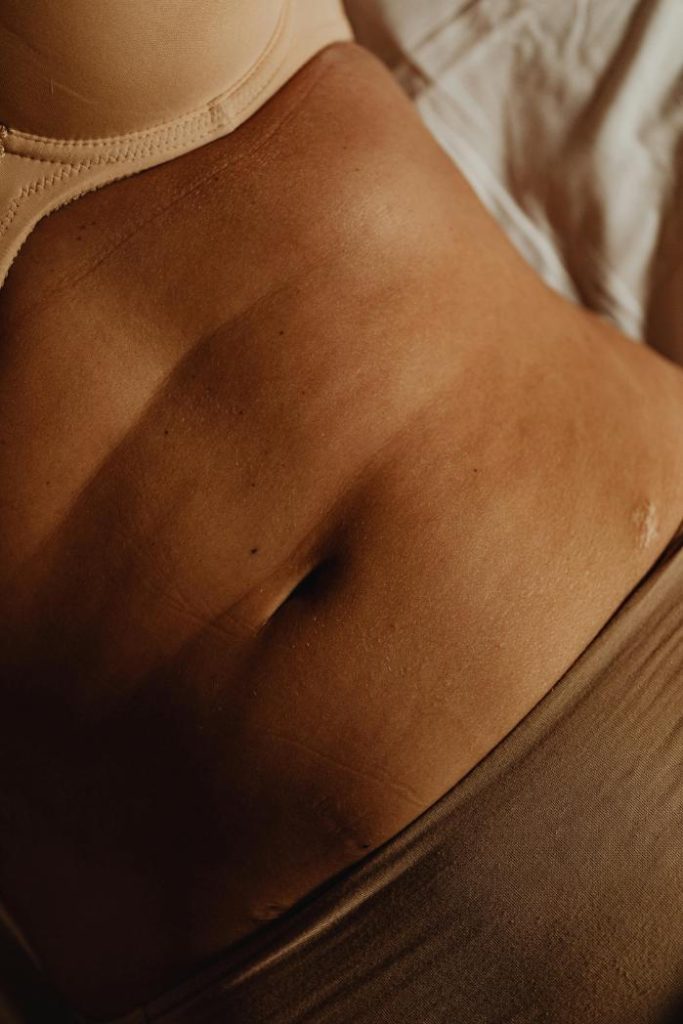 ¿Cómo se arregla la diastasis abdominal?